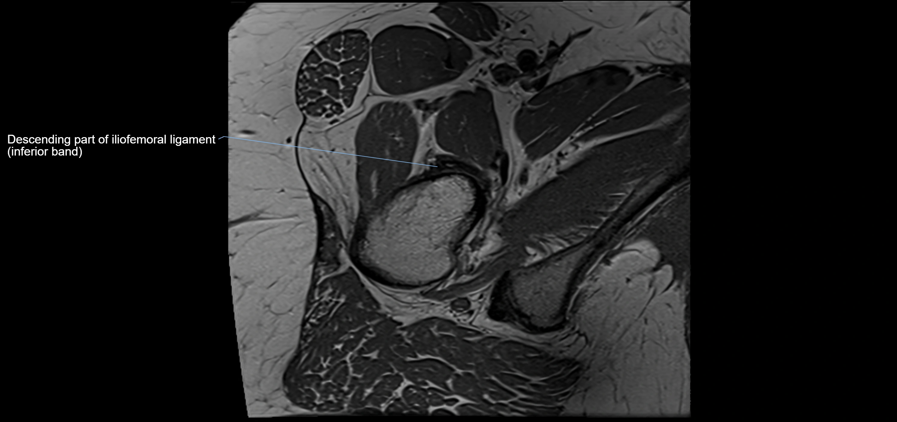 Hip ligament anatomy axial 3T MRI image -img-13001-00026.webp